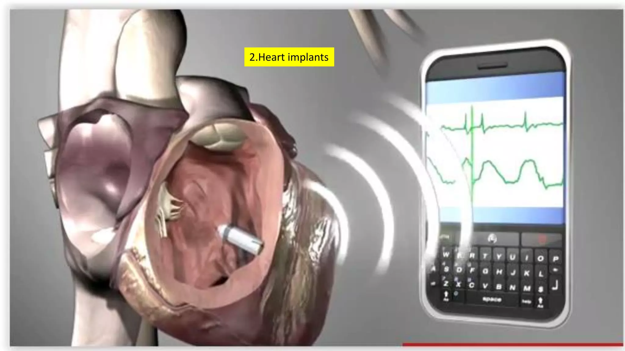 2.Heart implants
 