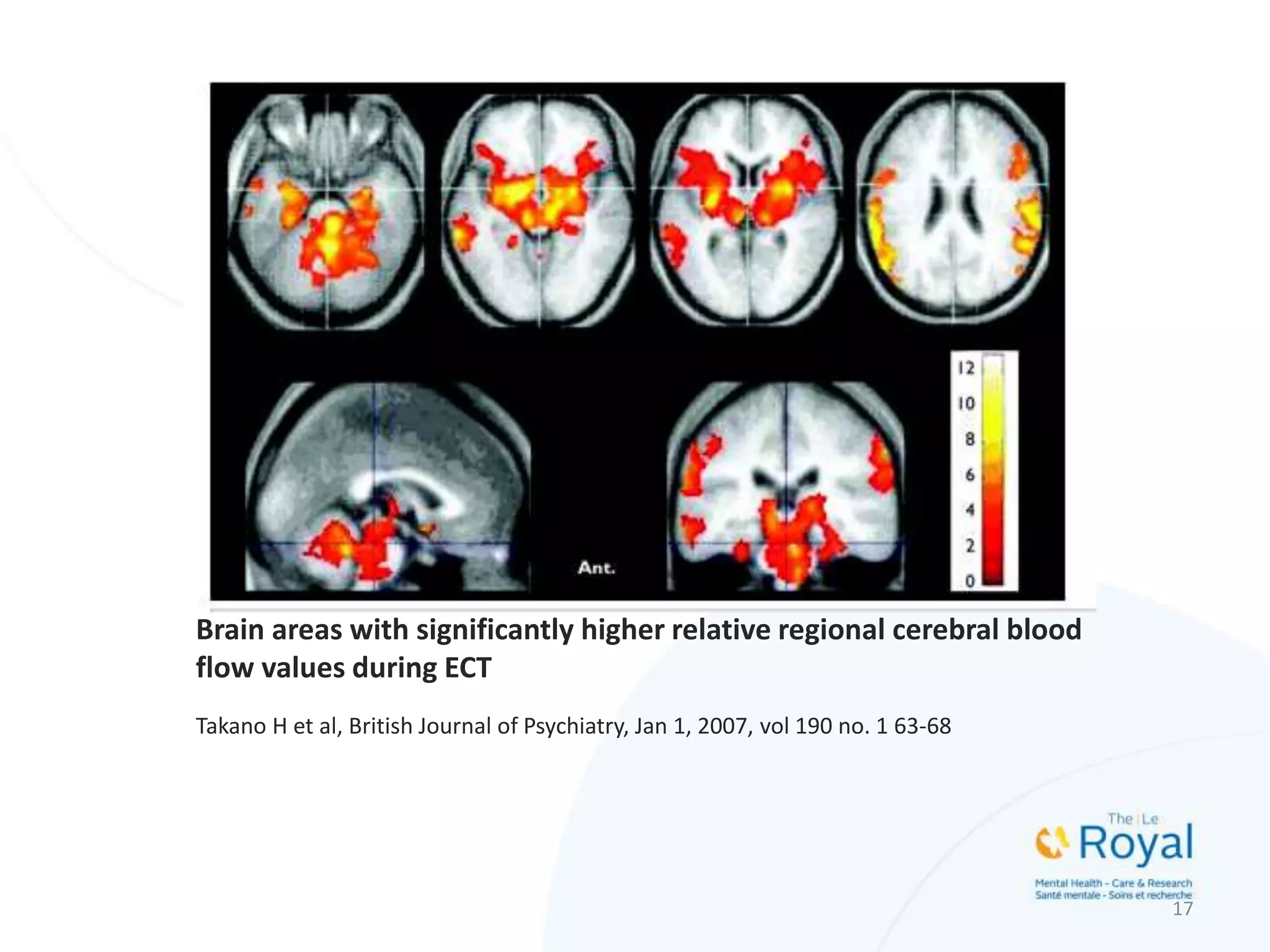 Brain areas with significantly higher relative regional cerebral blood
flow values during ECT
Takano H et al, British Journal of Psychiatry, Jan 1, 2007, vol 190 no. 1 63-68
17
 