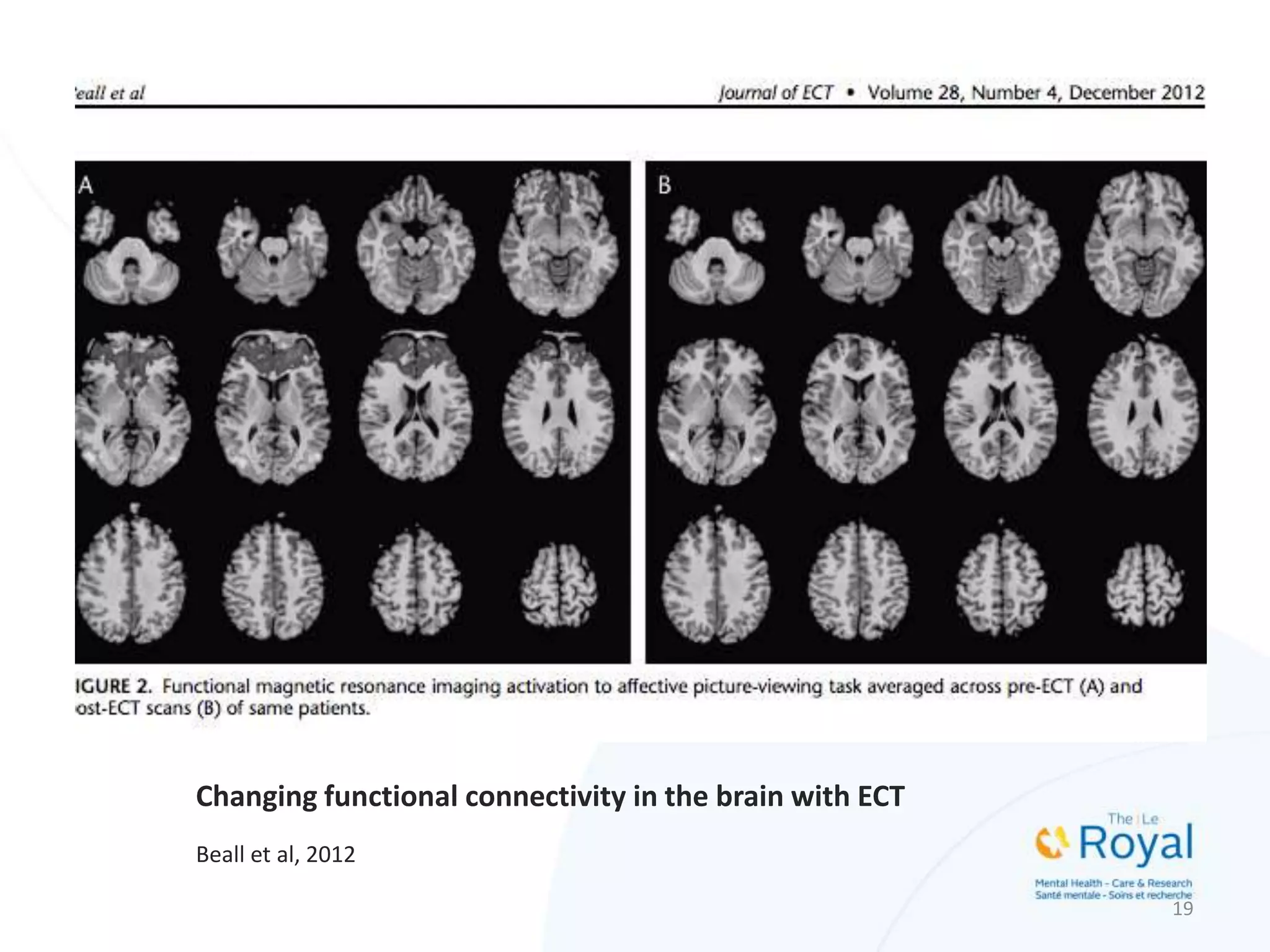 Changing functional connectivity in the brain with ECT
Beall et al, 2012
19
 