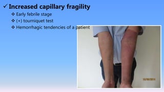 Dengue Fever.ppt