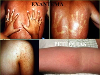 COSTA RICA EXANTEMA PETÉQUIAS 