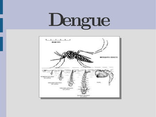 Dengue