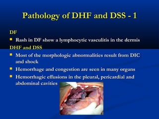 Dengue | PPT