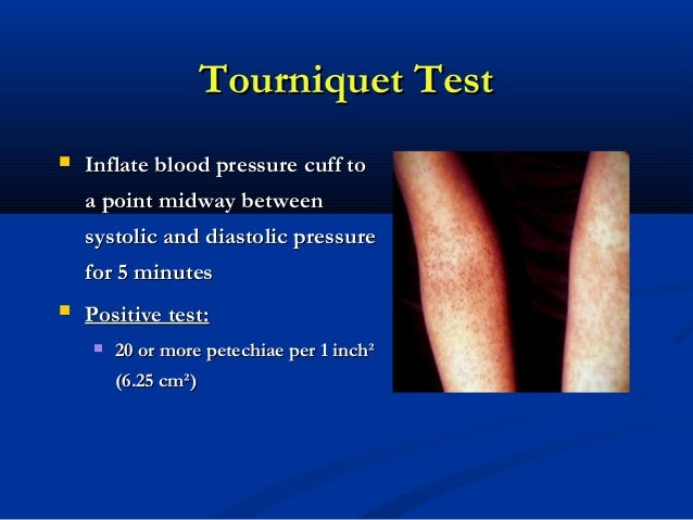 blood hematocrit test Dengue blood hematocrit test Dengue