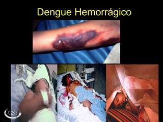 Dengue Hemorrágico
 