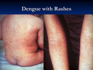 Dengue with Rashes
 
