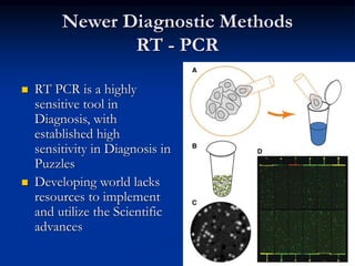 Newer Diagnostic Methods
RT - PCR
 RT PCR is a highly
sensitive tool in
Diagnosis, with
established high
sensitivity in Diagnosis in
Puzzles
 Developing world lacks
resources to implement
and utilize the Scientific
advances
 