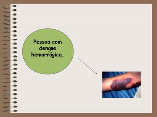 Pessoa com
dengue
hemorrágica.
 
