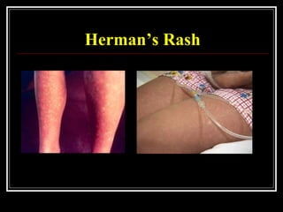 Herman S Rash Dengue Hemorrhagic Fever | PPT