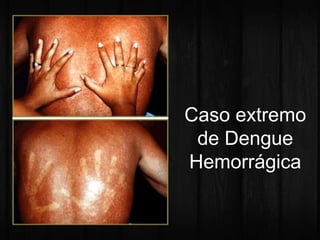 Caso extremo 
de Dengue 
Hemorrágica 
 