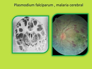 Plasmodium falcíparum , malaria cerebral 
 