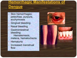 Hemorrhagic Manifestations of
Dengue
• Skin hemorrhages:
petechiae, purpura,
ecchymoses
• Gingival bleeding
• Nasal bleeding
• Gastrointestinal
bleeding:
Hematemesis,
melena, hematochezia
• Hematuria
• Increased menstrual
flow
 