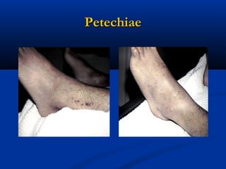 PetechiaePetechiae
 