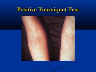 Positive Tourniquet TestPositive Tourniquet Test
 
