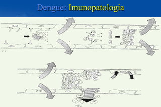 Dengue:Dengue: ImunopatologiaImunopatologia
 