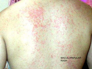 Herman S Rash Dengue | PPTX