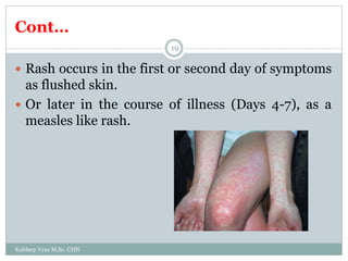 Cont…
Kuldeep Vyas M.Sc. CHN
19
 Rash occurs in the first or second day of symptoms
as flushed skin.
 Or later in the course of illness (Days 4-7), as a
measles like rash.
 