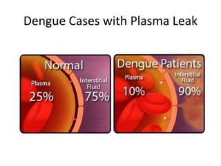 Dengue Cases with Plasma Leak
 