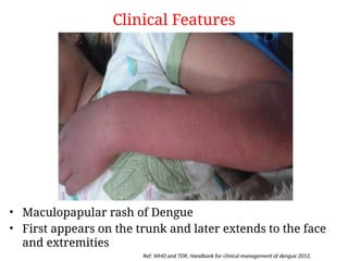 Herman S Rash Dengue Diagnosis and Management Indian.pptx