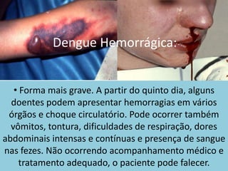 Dengue Hemorrágica:
• Forma mais grave. A partir do quinto dia, alguns
doentes podem apresentar hemorragias em vários
órgãos e choque circulatório. Pode ocorrer também
vômitos, tontura, dificuldades de respiração, dores
abdominais intensas e contínuas e presença de sangue
nas fezes. Não ocorrendo acompanhamento médico e
tratamento adequado, o paciente pode falecer.
 