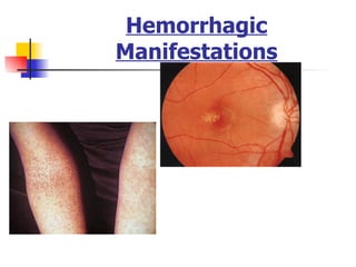 Hemorrhagic Manifestations 