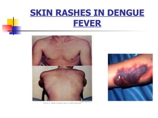 SKIN RASHES IN DENGUE FEVER 