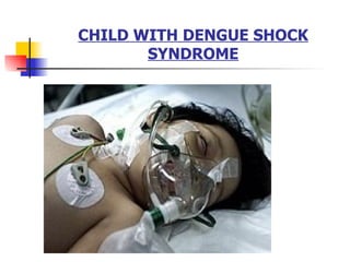 CHILD WITH DENGUE SHOCK SYNDROME 