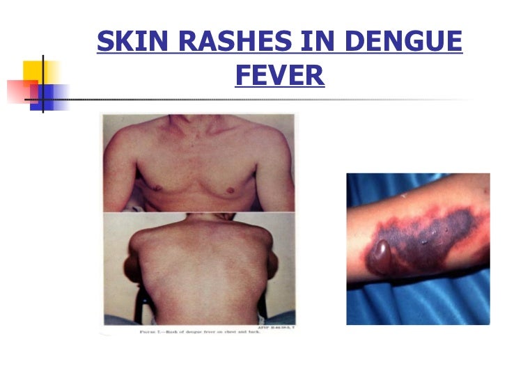 Dengue Rashes Itchy - Doctor insights on HealthTap