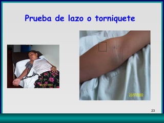 Prueba de lazo o torniquete 