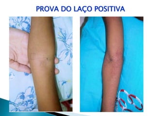 PROVA DO LAÇO POSITIVA
 