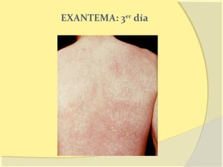 EXANTEMA: 3er día
 