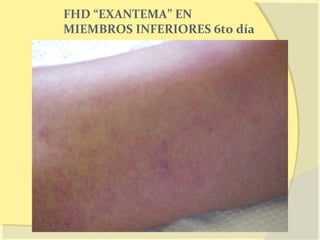 FHD “EXANTEMA” EN
MIEMBROS INFERIORES 6to día
 