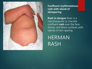 Herman S Rash dengue .pptx
