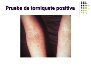 Prueba de torniquete positivaPrueba de torniquete positiva
 