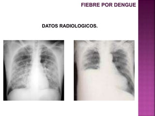 FIEBRE POR DENGUE
 