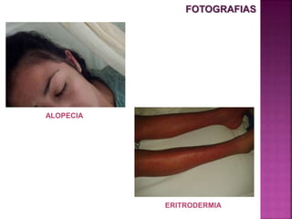 FOTOGRAFIAS
ALOPECIA
ERITRODERMIA
 