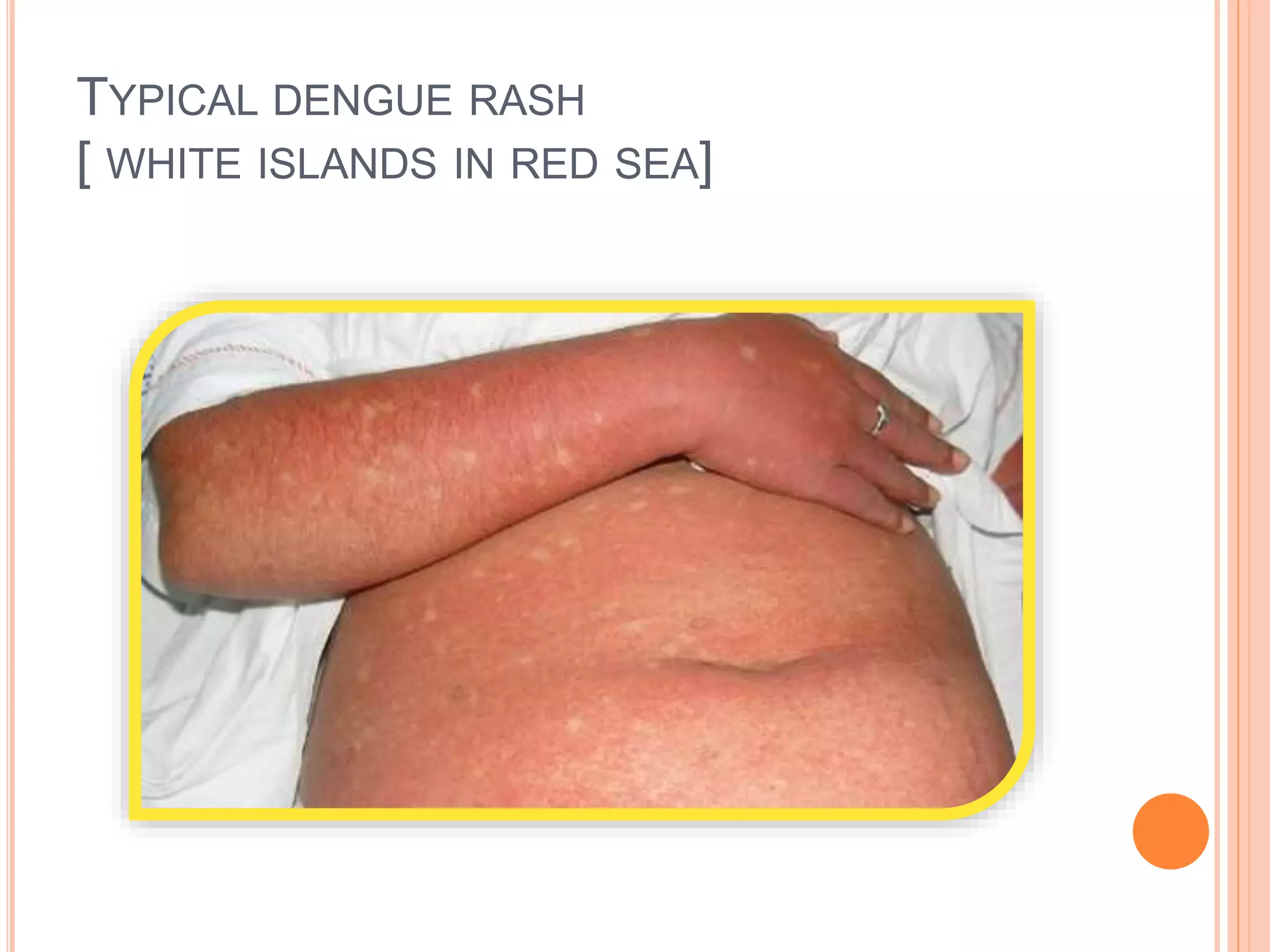 Dengue and chikungunya in Children | PPTX