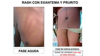 Herman S Rash Dengue diresa 2023 tratamiento actualizado | PPTX