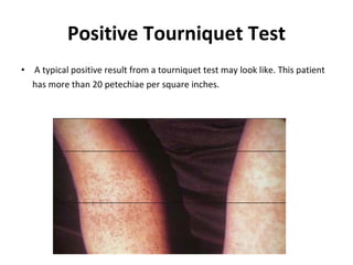 Positive Tourniquet Test A typical positive result from a tourniquet test may look like. This patient has more than 20 petechiae per square inches.  