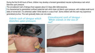 Herman S Rash Dengue fever | PPTX