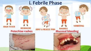 i. Febrile Phase
Petechiae rashes Mucosal bleeding
 
