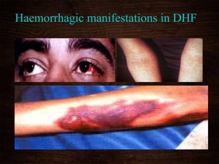 Haemorrhagic manifestations in DHF
 