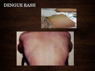 DENGUE RASH
 