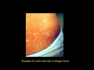 Dengue Fever | PPT