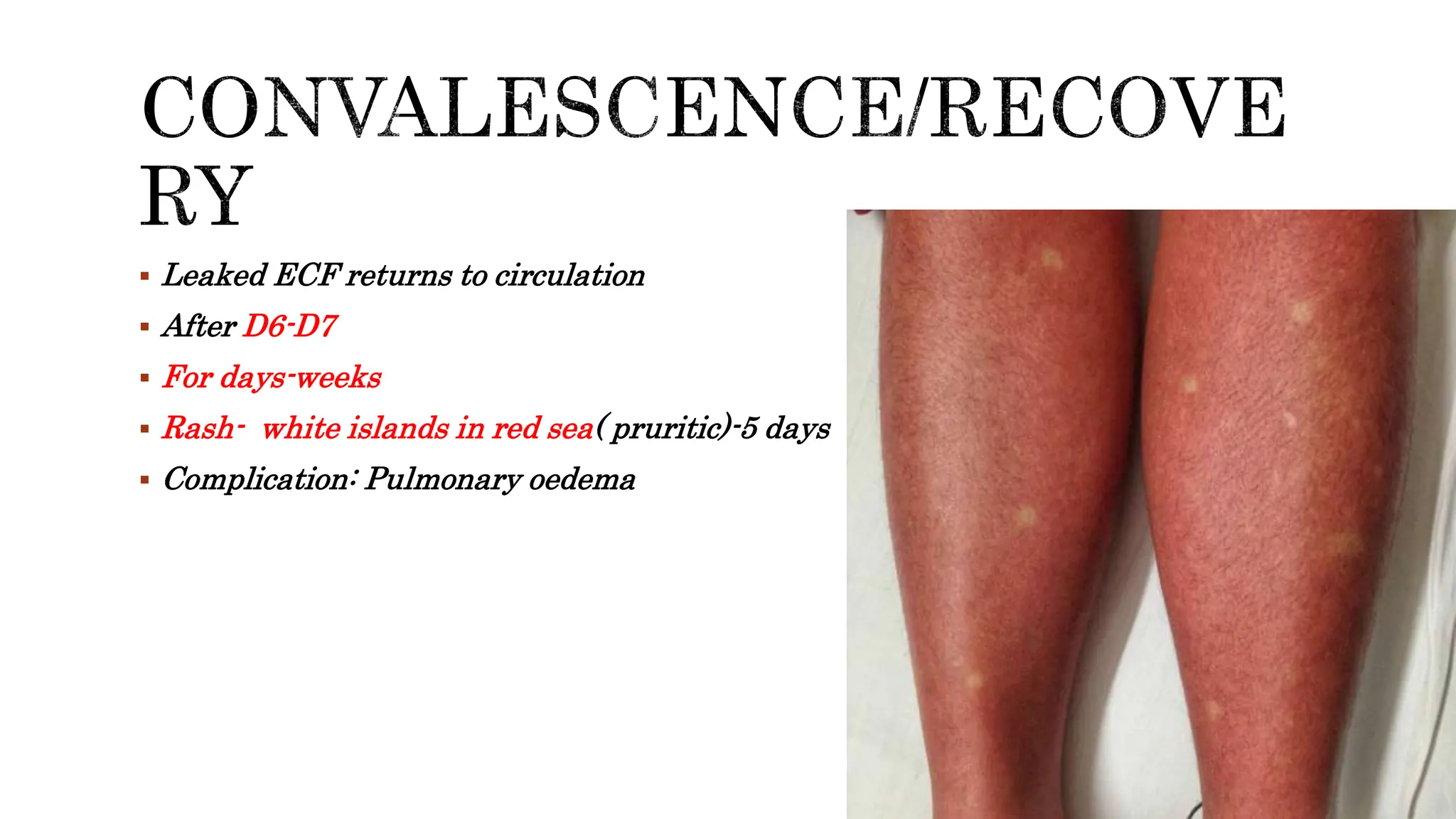DENGUE FEVER.pathogenesis, clinical features and management.pptx