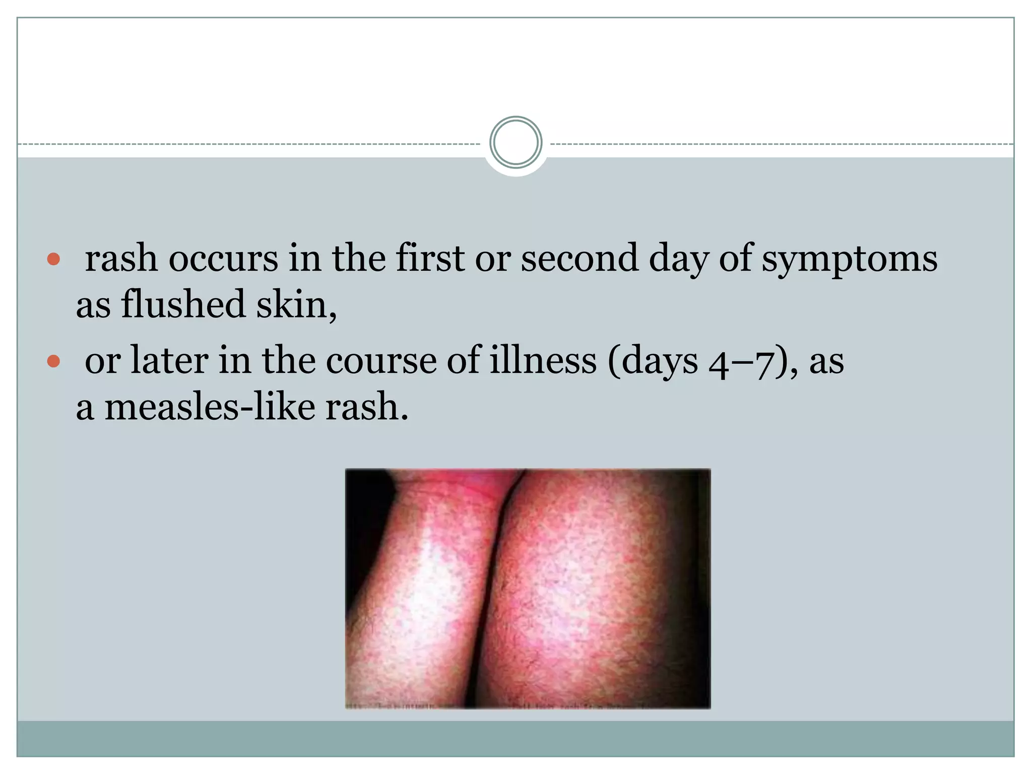 rash occurs in the first or second day of symptoms
  as flushed skin,
 or later in the course of illness (days 4–7), as
  a measles-like rash.
 