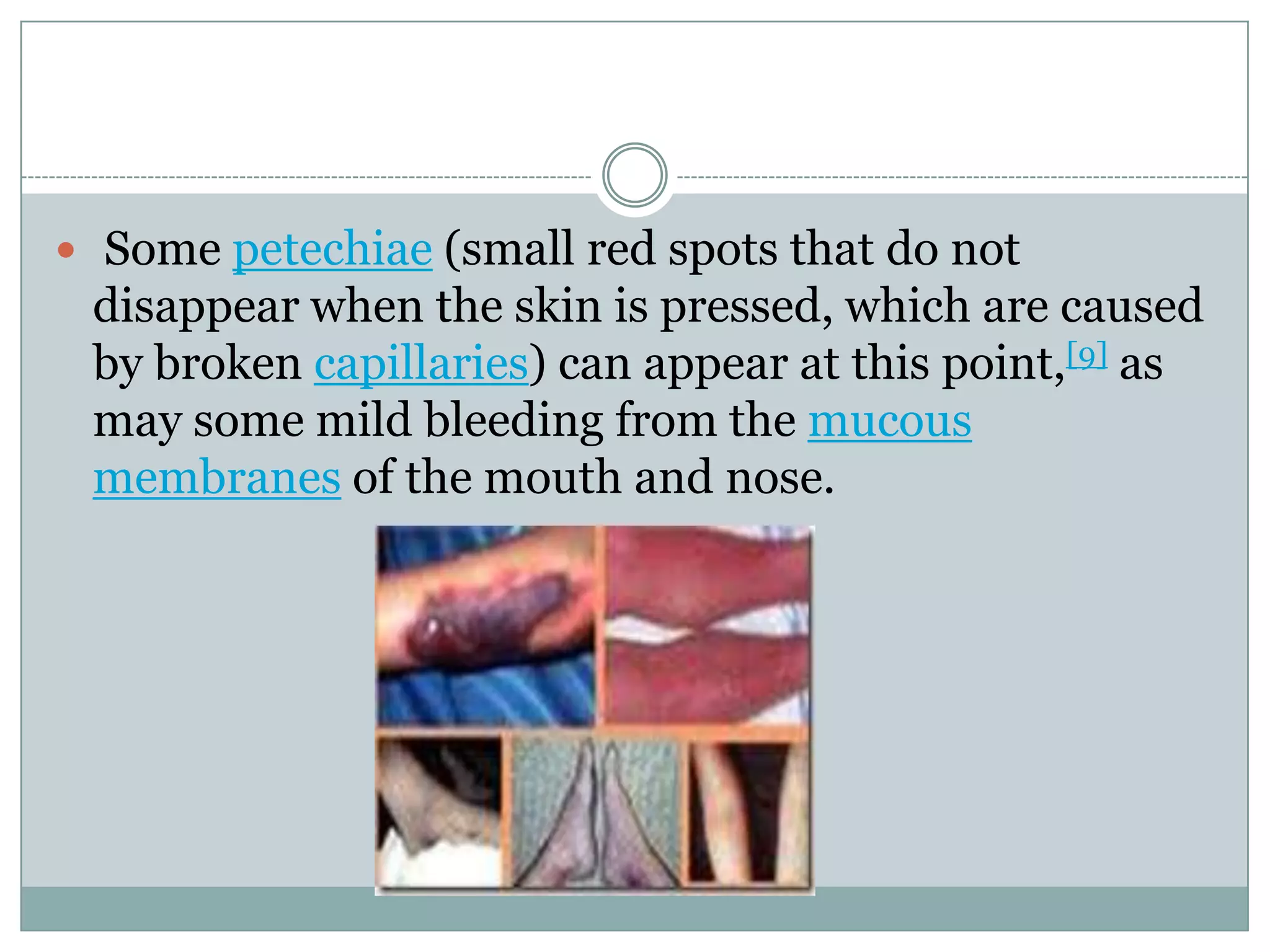  Some petechiae (small red spots that do not
 disappear when the skin is pressed, which are caused
 by broken capillaries) can appear at this point,[9] as
 may some mild bleeding from the mucous
 membranes of the mouth and nose.
 