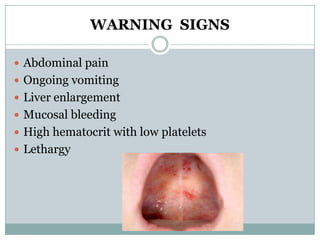 WARNING SIGNS

 Abdominal pain
 Ongoing vomiting
 Liver enlargement
 Mucosal bleeding
 High hematocrit with low platelets
 Lethargy
 