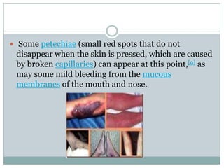 Some petechiae (small red spots that do not
 disappear when the skin is pressed, which are caused
 by broken capillaries) can appear at this point,[9] as
 may some mild bleeding from the mucous
 membranes of the mouth and nose.
 