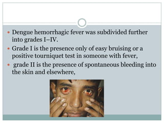  Dengue hemorrhagic fever was subdivided further
  into grades I–IV.
 Grade I is the presence only of easy bruising or a
  positive tourniquet test in someone with fever,
 grade II is the presence of spontaneous bleeding into
  the skin and elsewhere,
 